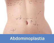 abdominoplastia