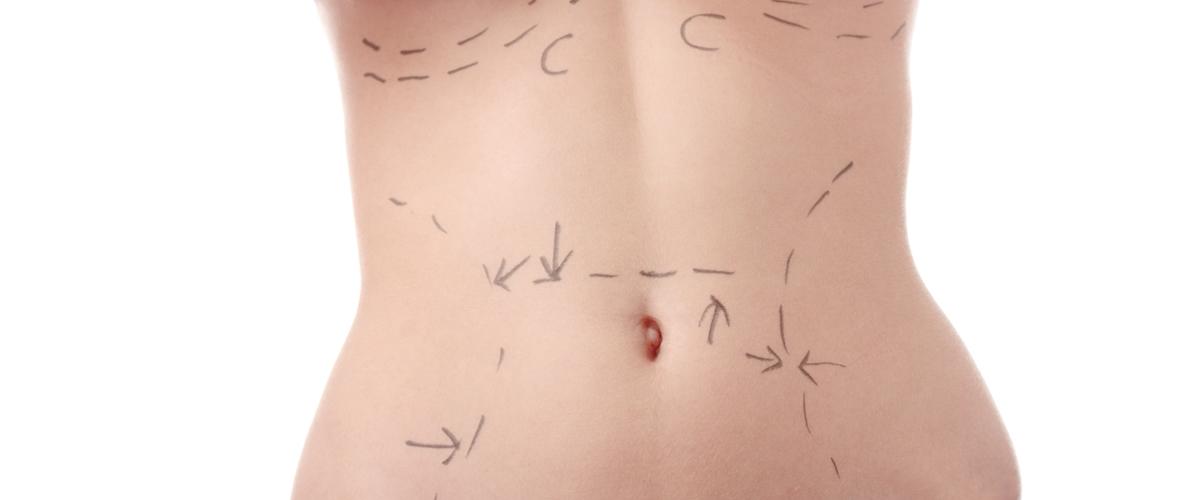 Abdominoplastia